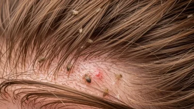 Lice Look Like in Hair